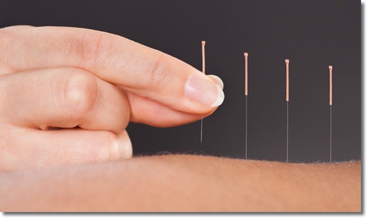 acupunt